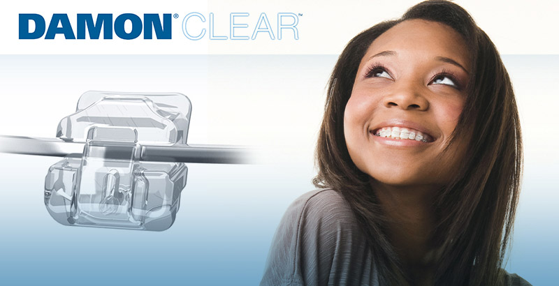 damon_clear_12.jpg damon_clear_12.jpg