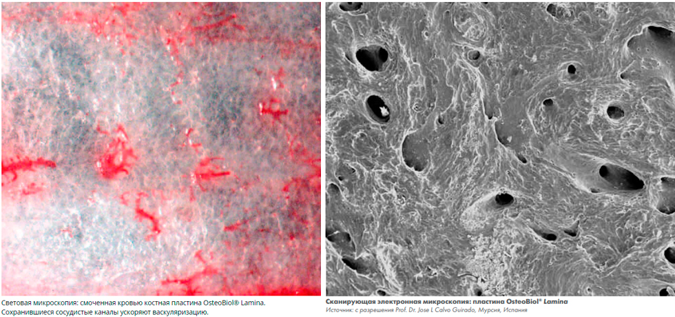 Osteobiol-Soft-Cortical-Lamina.jpg