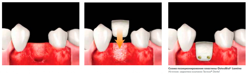 Osteobiol-Soft-Cortical-Lamina2.jpg