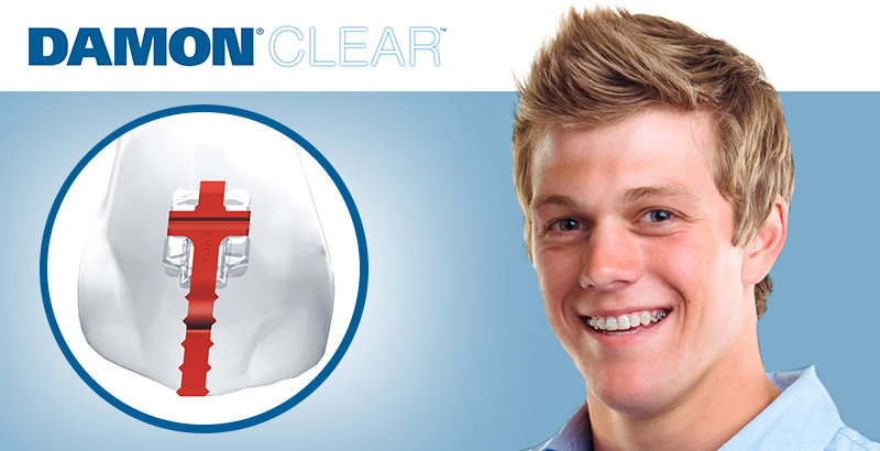 damon_clear_0_8.jpg damon_clear_0_8.jpg